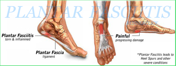 plantar fasciitis